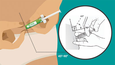 G. Hold the pinch. Insert the needle into the skin at 45 to 90 degrees.